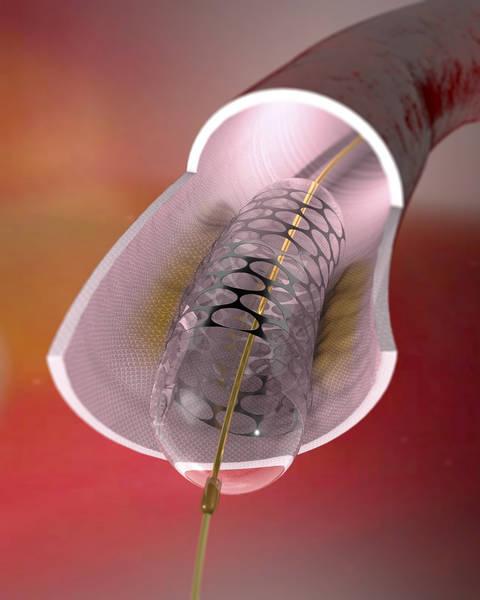 Dilatation et implantation valvulaire aortique TAVI 2